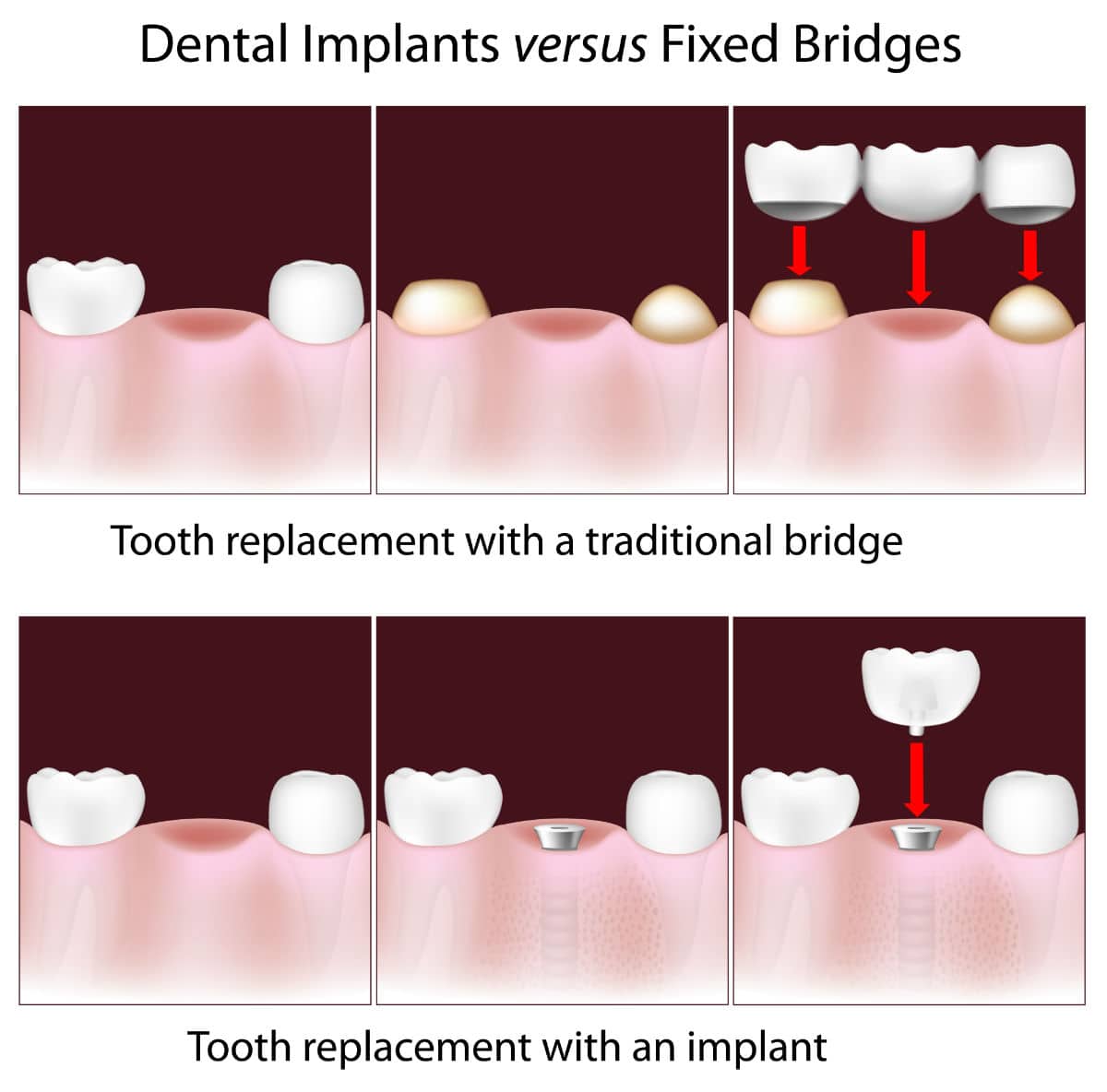 Dental Implants Or Bridges?