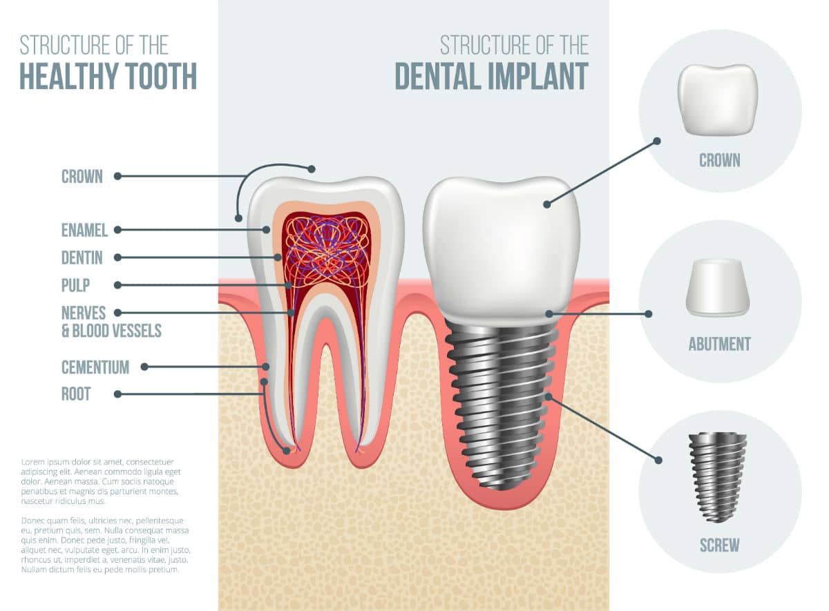 What Is A Dental Implant