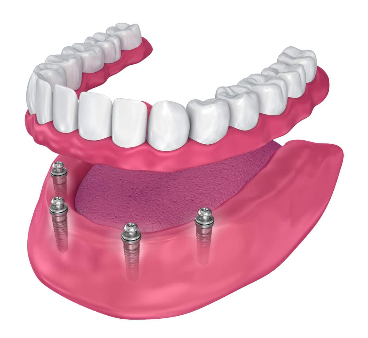 Dentures or Dental Implants