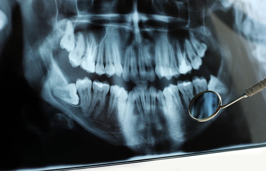 Are Dental X-rays Safe for Pregnant Women?