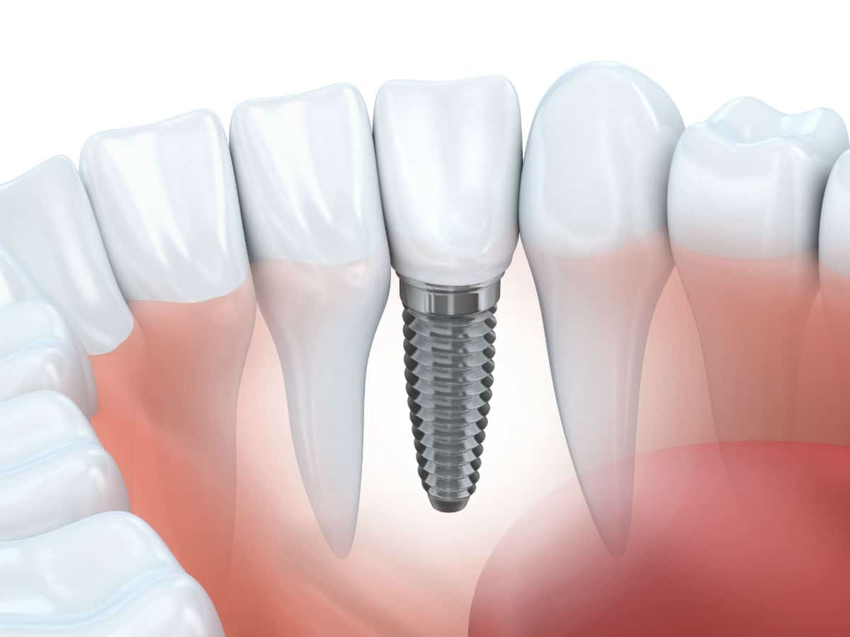 5 Things To Keep In Mind When Choosing A Dentist For Dental Implants​