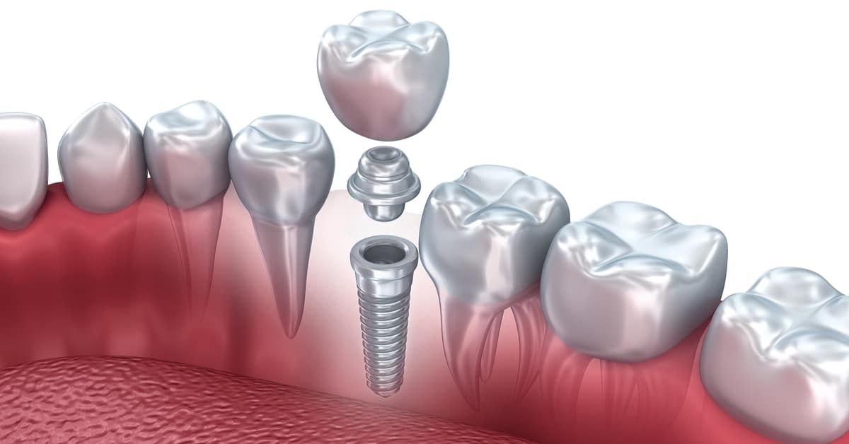 Dental Implants – Procedures and Expectations