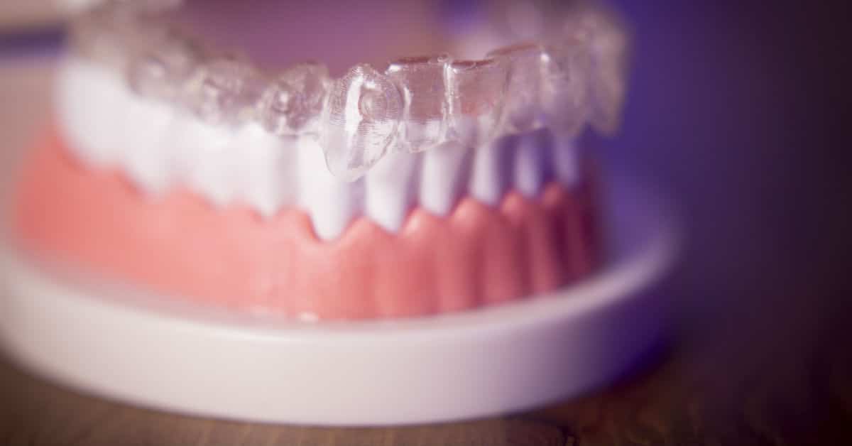 5 Major Differences Between Traditional Braces And Invisalign