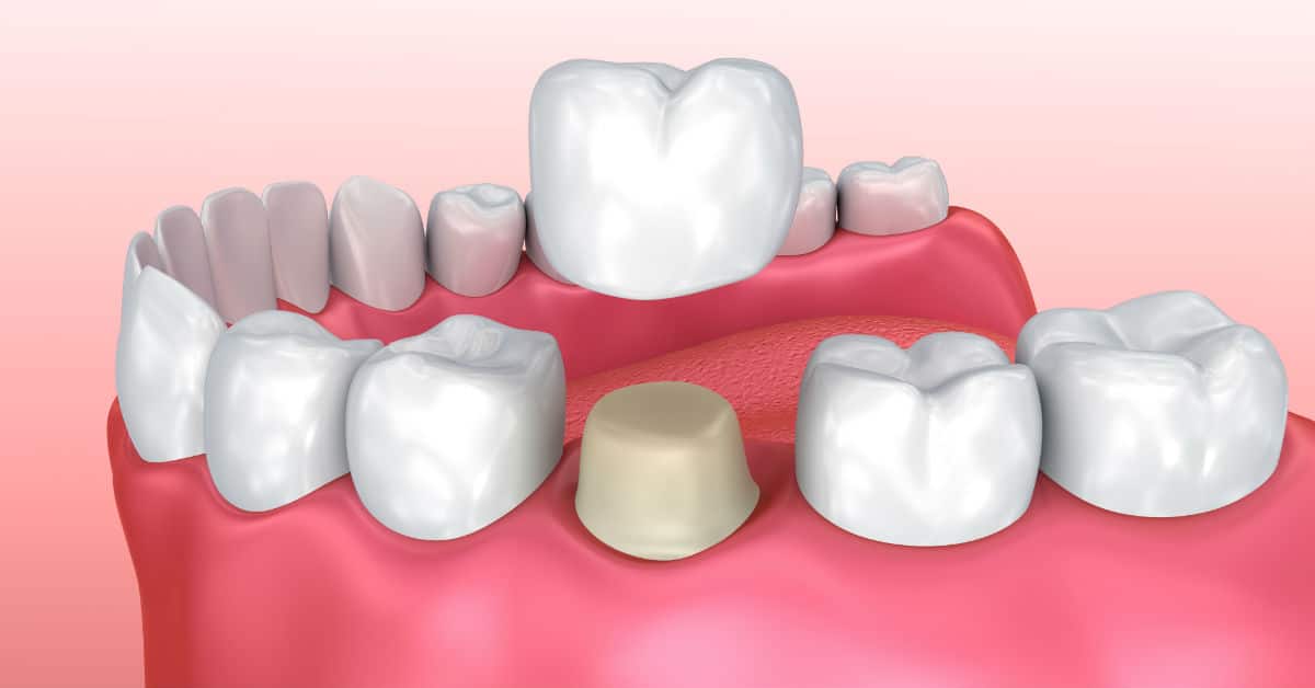 Dentist Digest Monthly: What Happens When You Get A Crown