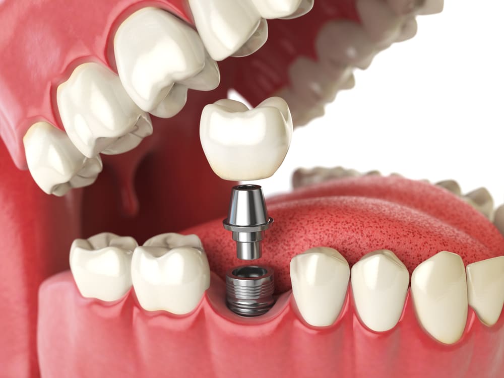 Steps Towards Getting Dental Implants