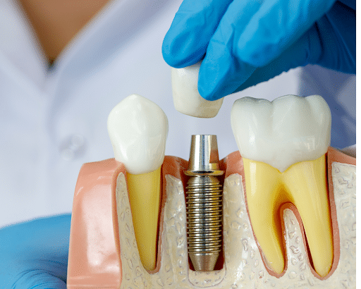 dental implant or dental crown billings dentist