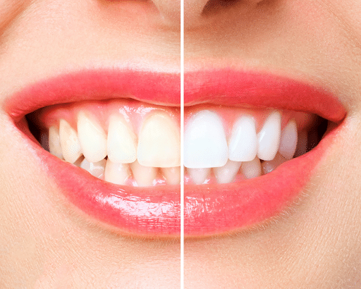 teeth whitening billings dentist