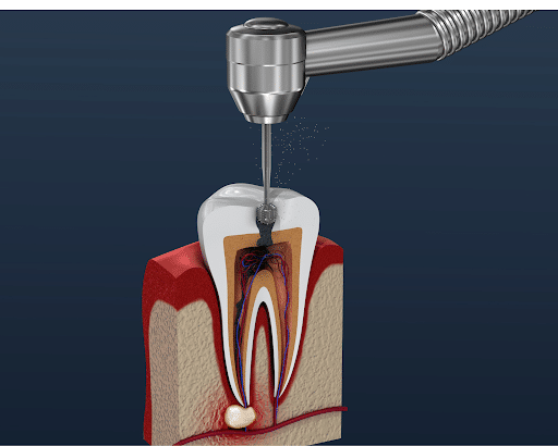 Root Canal Pain Signs and Symptoms