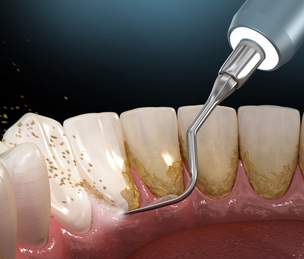 dental scaling bridge creek dental