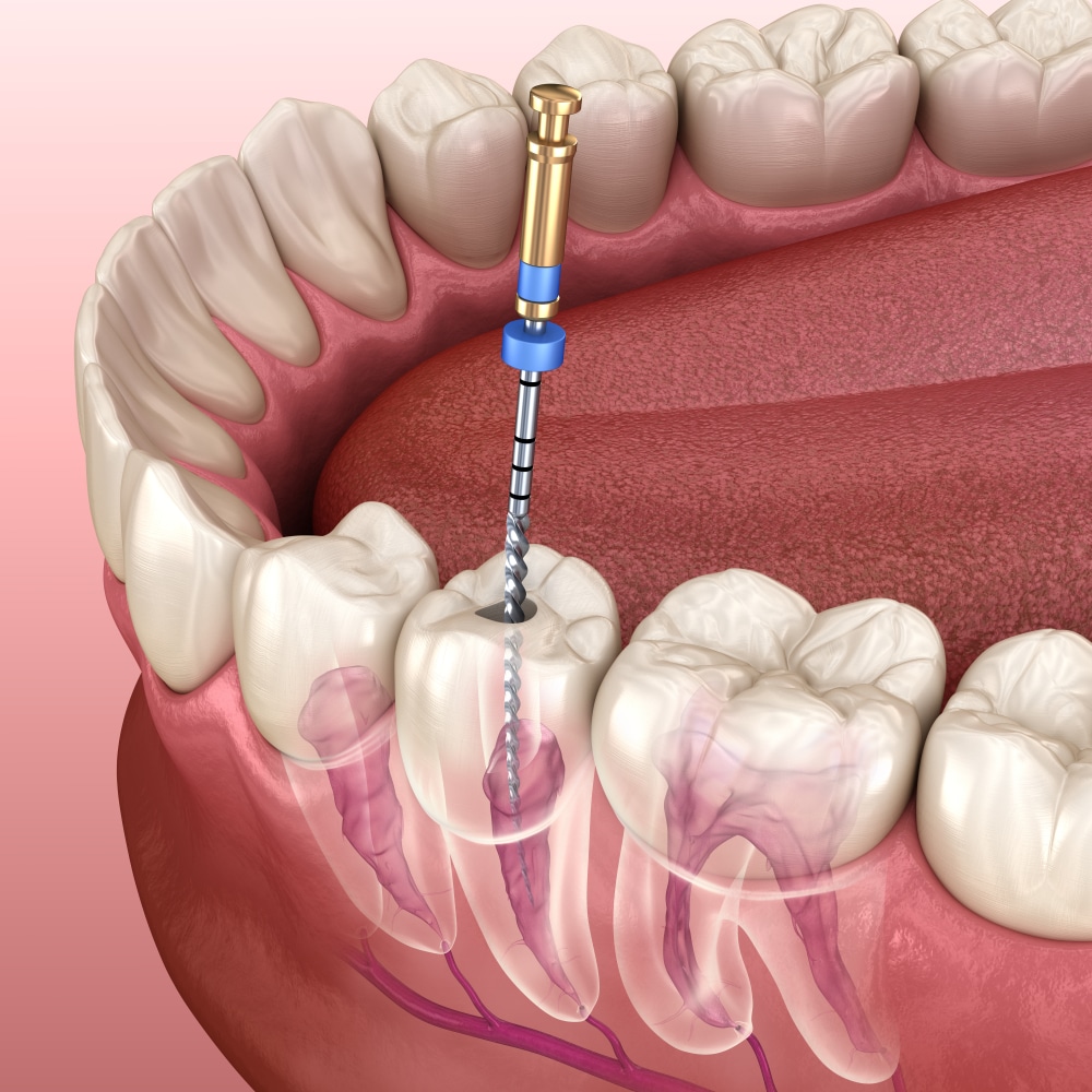 root canal fail bridge creek dental